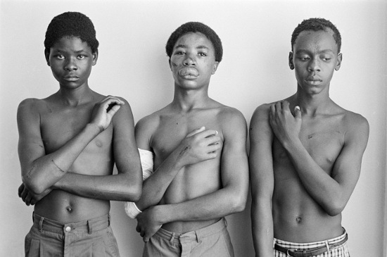 Zacharia Rapoo (16) Johannes Pilane (17) and Vitalious Xaba (17) Khatlehong youth beaten by police in Johannesburg, Gauteng, March 1988. Photograph by Gille de Vlieg